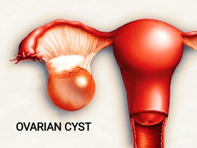 Ovarian cyst - What Causes It?