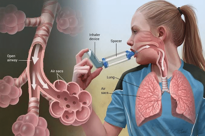 Asthma And Homeopathy!