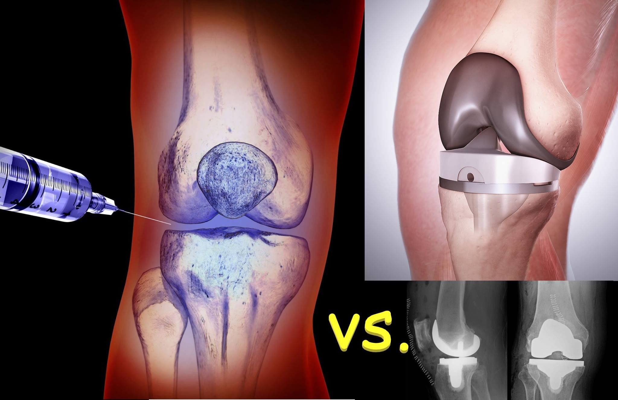 What Is Best - Knee Injections Or Knee Replacement?