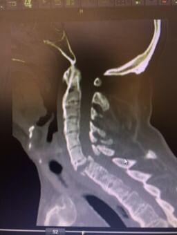 Fracture cervical vertebrae
