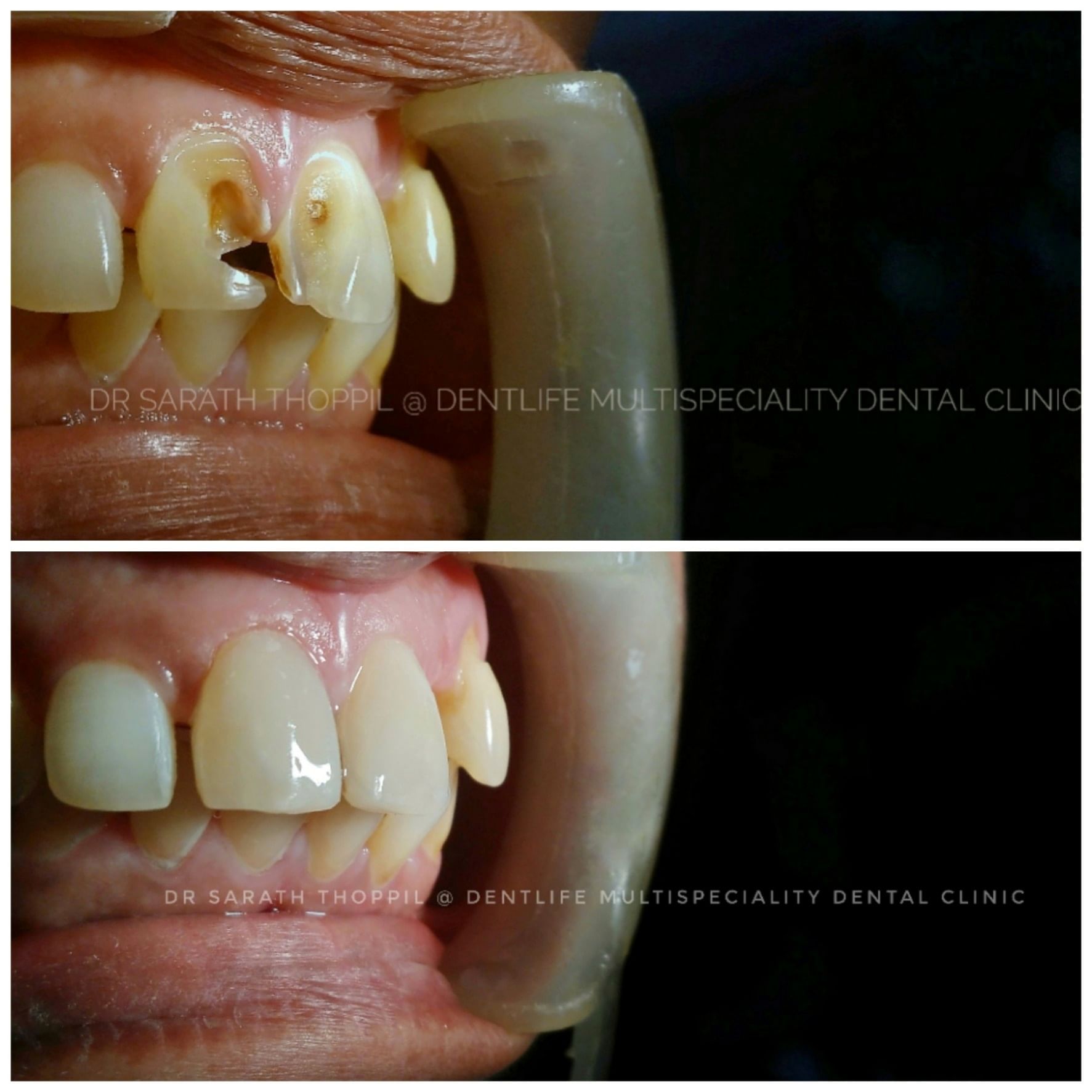 Tooth colour fillings