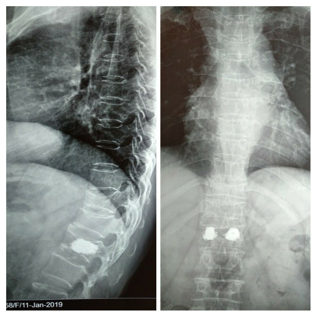 Osteoporosis And Spinal Vertebrae Fracture!
