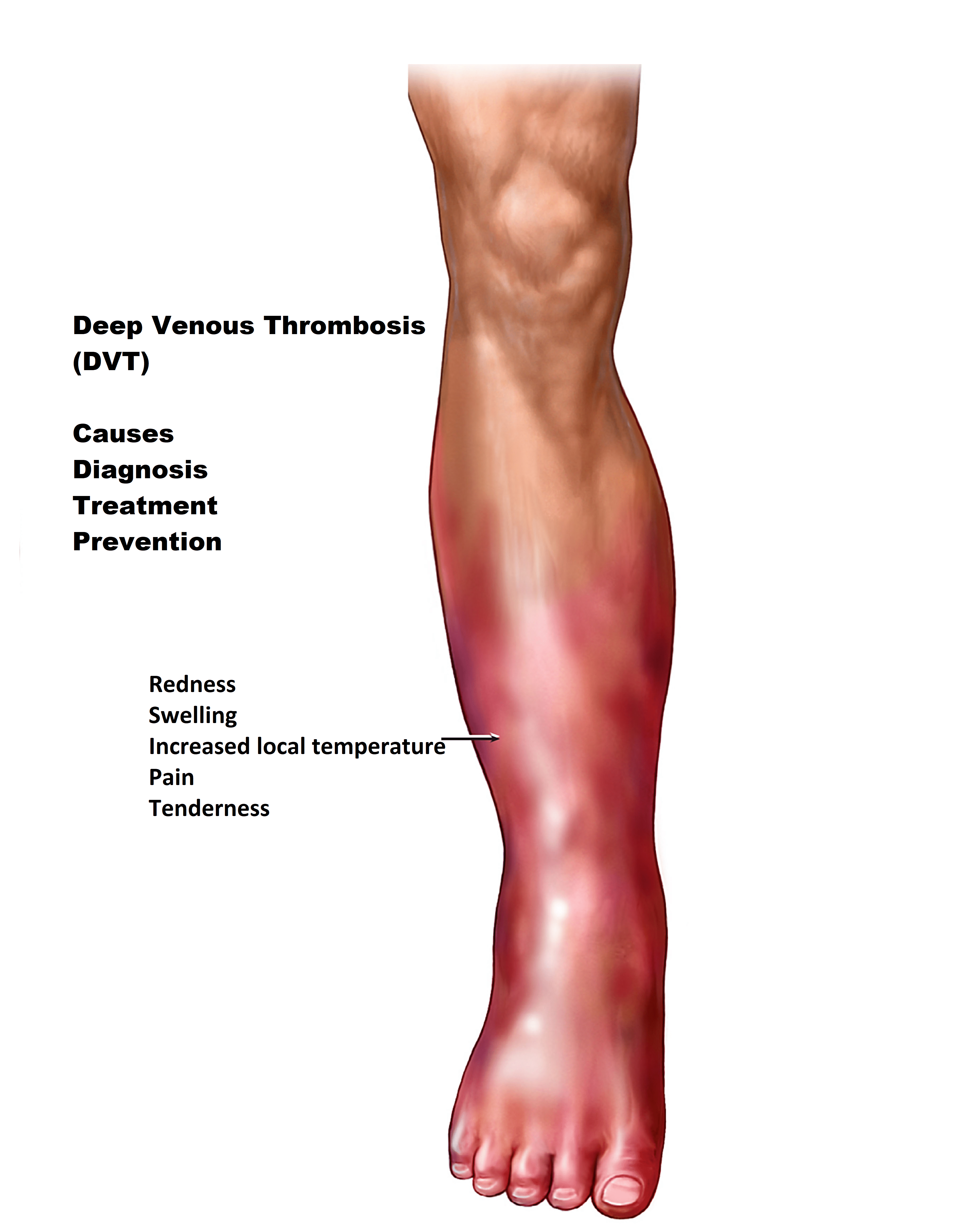 Deep Vein Thrombosis (DVT)