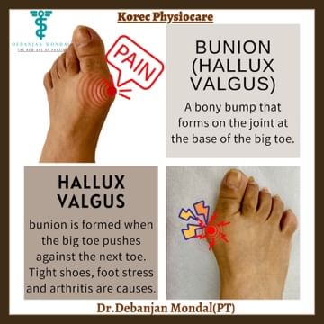 Bunion or HALLUX VALGUS Deformity