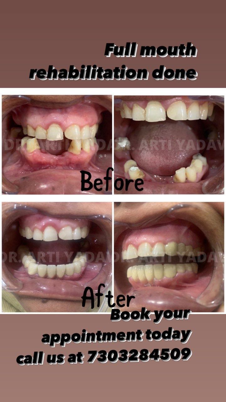 Full mouth Rehabilation done.
