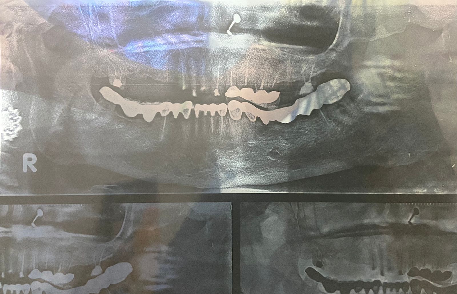 DENTAL IMPLANT SURGERY BEFORE AND AFTER XRAY