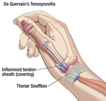 De Quervain's Tenosynovitis - Know More About It!