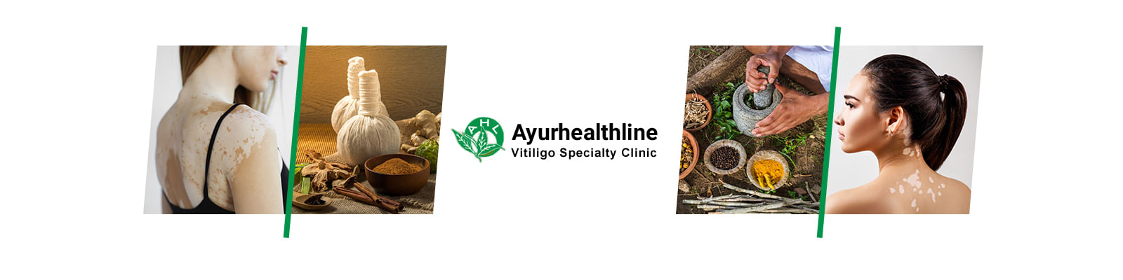 Ayurhealthline Vitiligo Clinic