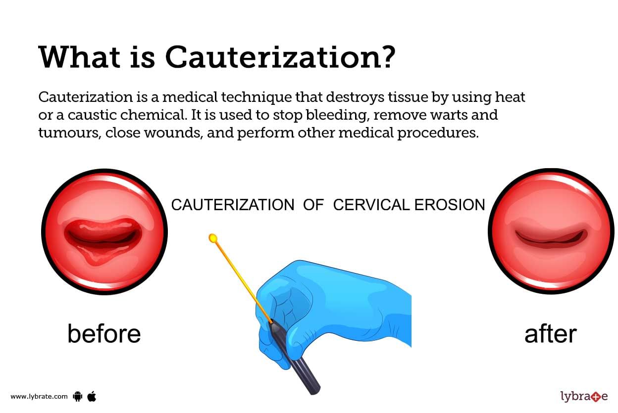 Cauterization causes symptoms treatment and cost