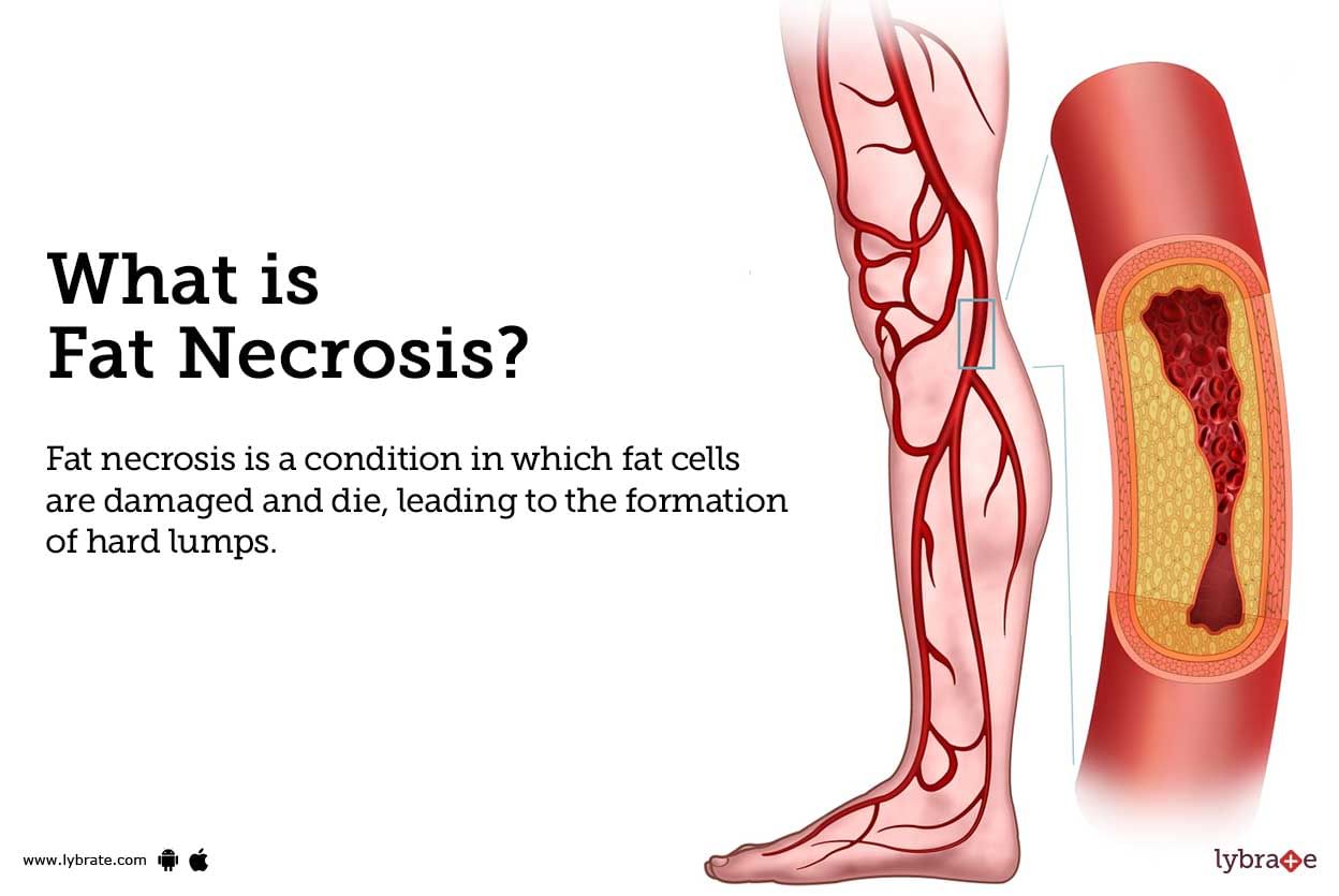 Fat Necrosis Causes, Symptoms, Treatment and Cost