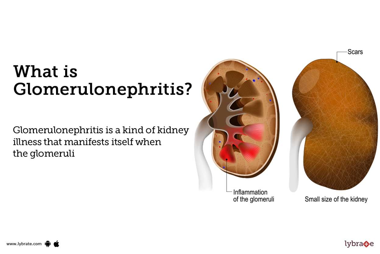 Glomerulonephritis Causes Symptoms Treatment And Cost 1854