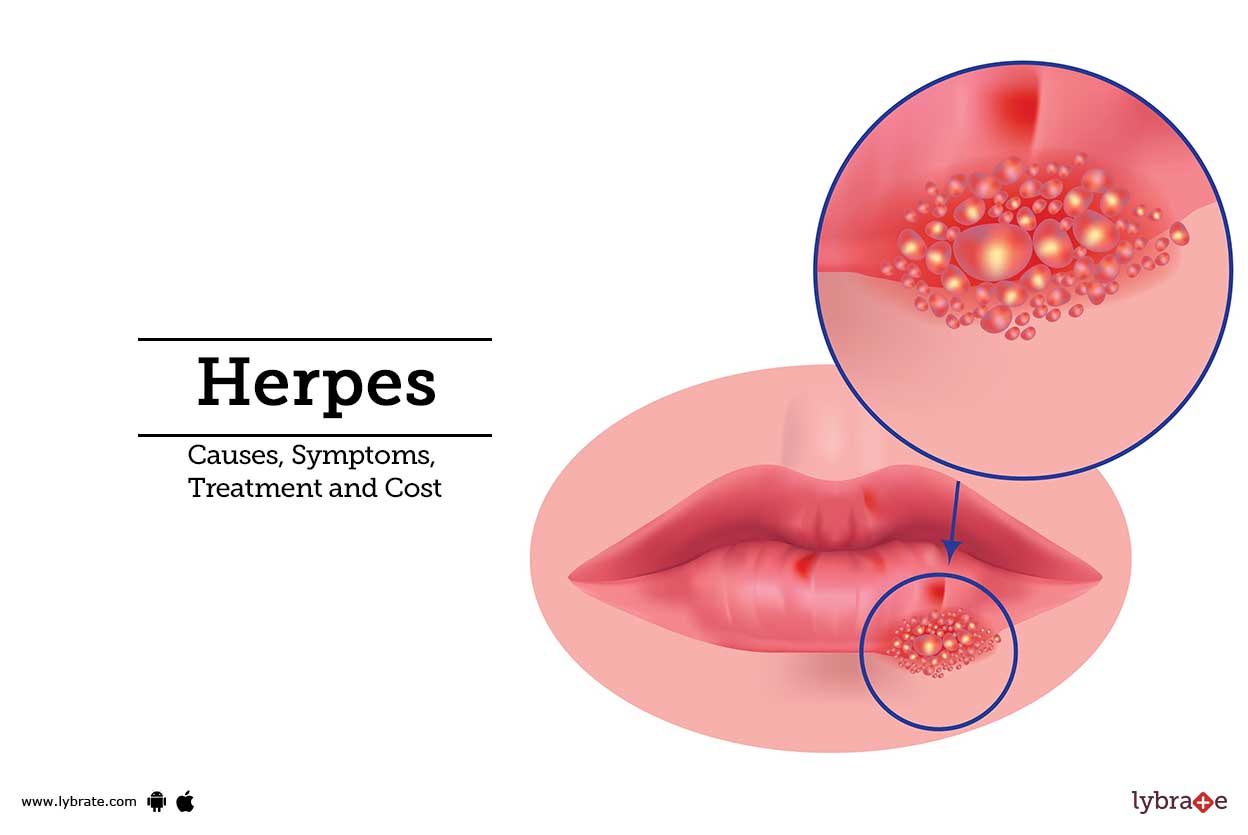 Herpes causes symptoms treatment and cost