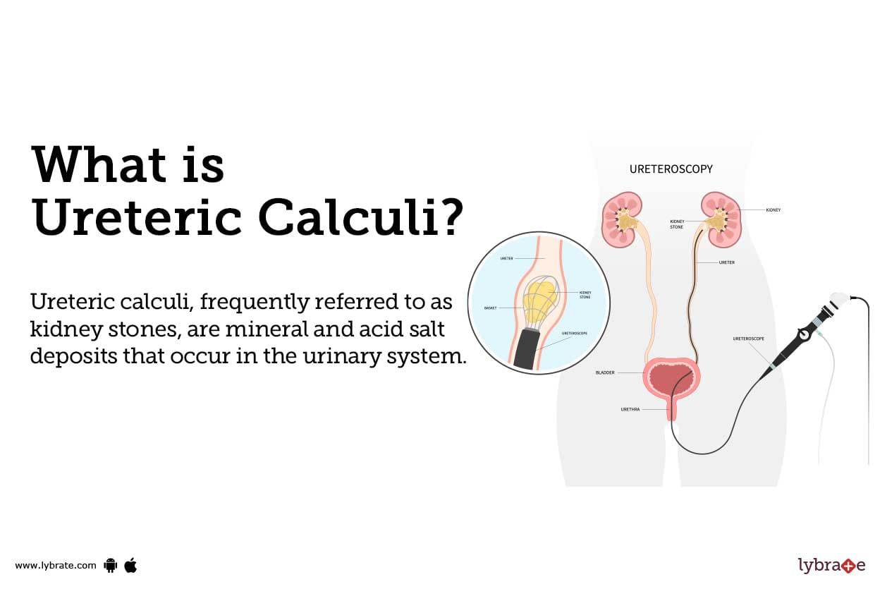 Right Ureteric Calculus Icd 10 Cm Code 2024 C - Alyda Moreen