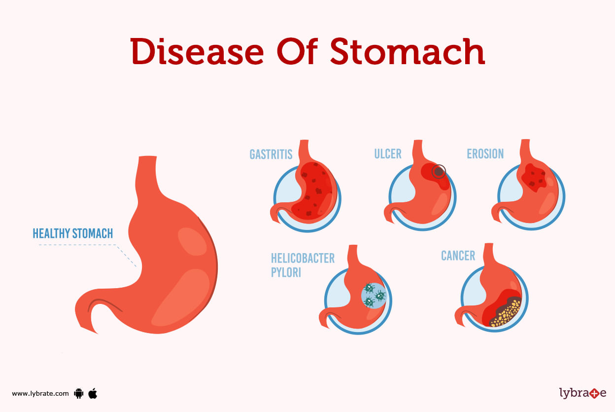 Stomach (Human Anatomy): Picture, Function, Diseases, and More