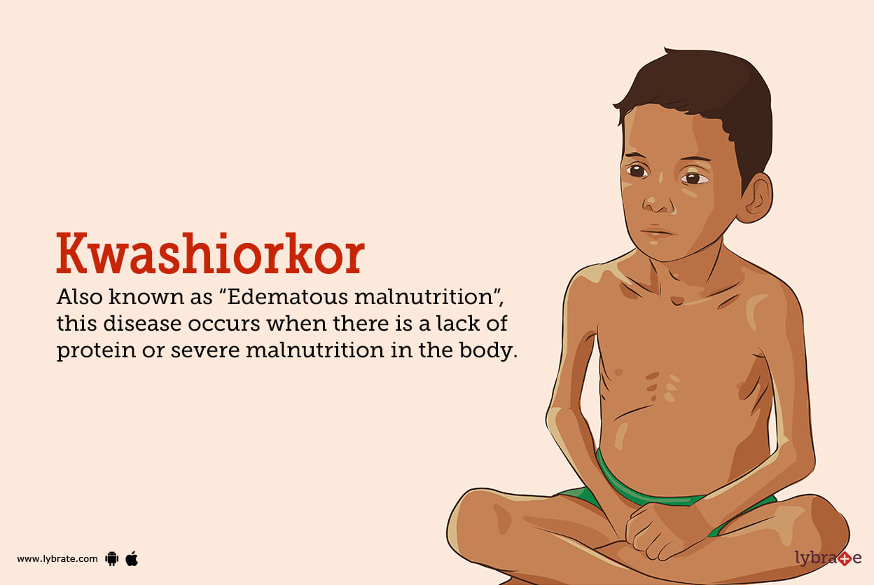 malnutrition-kwashiorkor-and-marasmus-symptoms-and-treatment