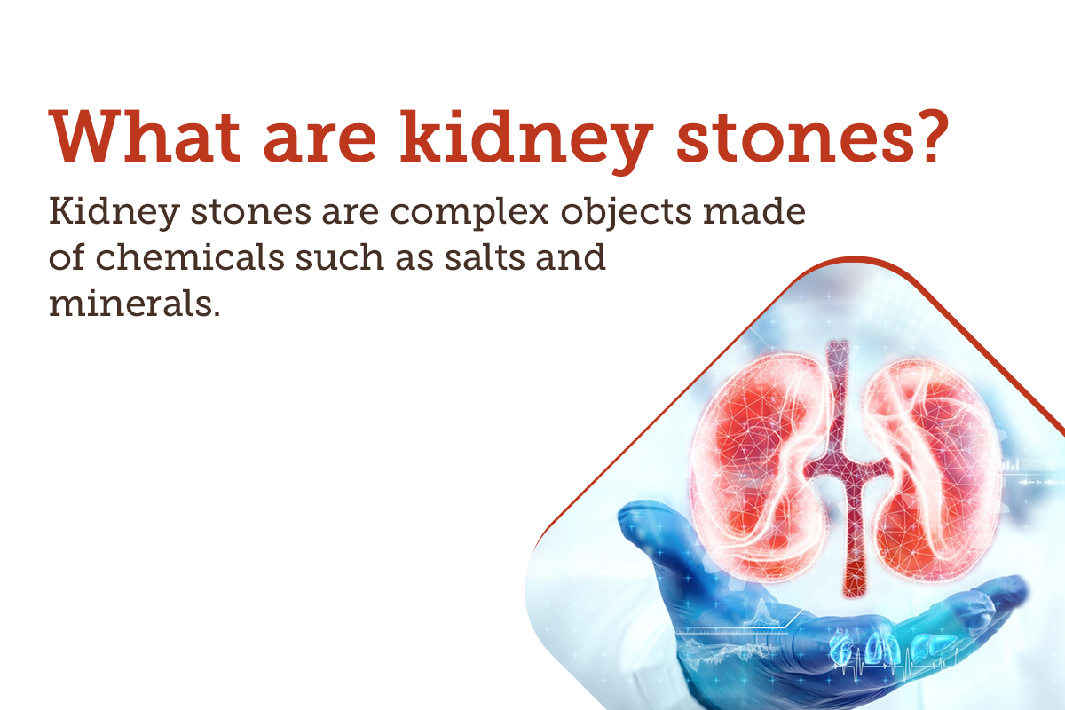 Kidney Stones: Causes, Symptoms, Treatments And More