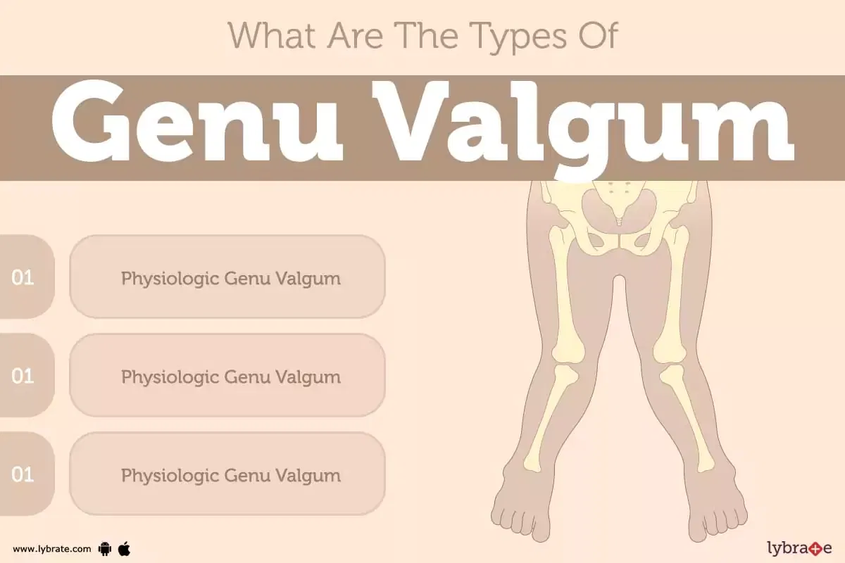 Genu Valgum Causes Symptoms Treatment And Cost