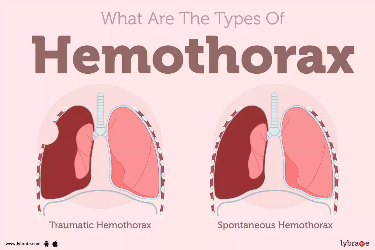 Hemothorax Causes Symptoms Treatment And Cost hemothorax-causes-symptoms-treatment-and-cost