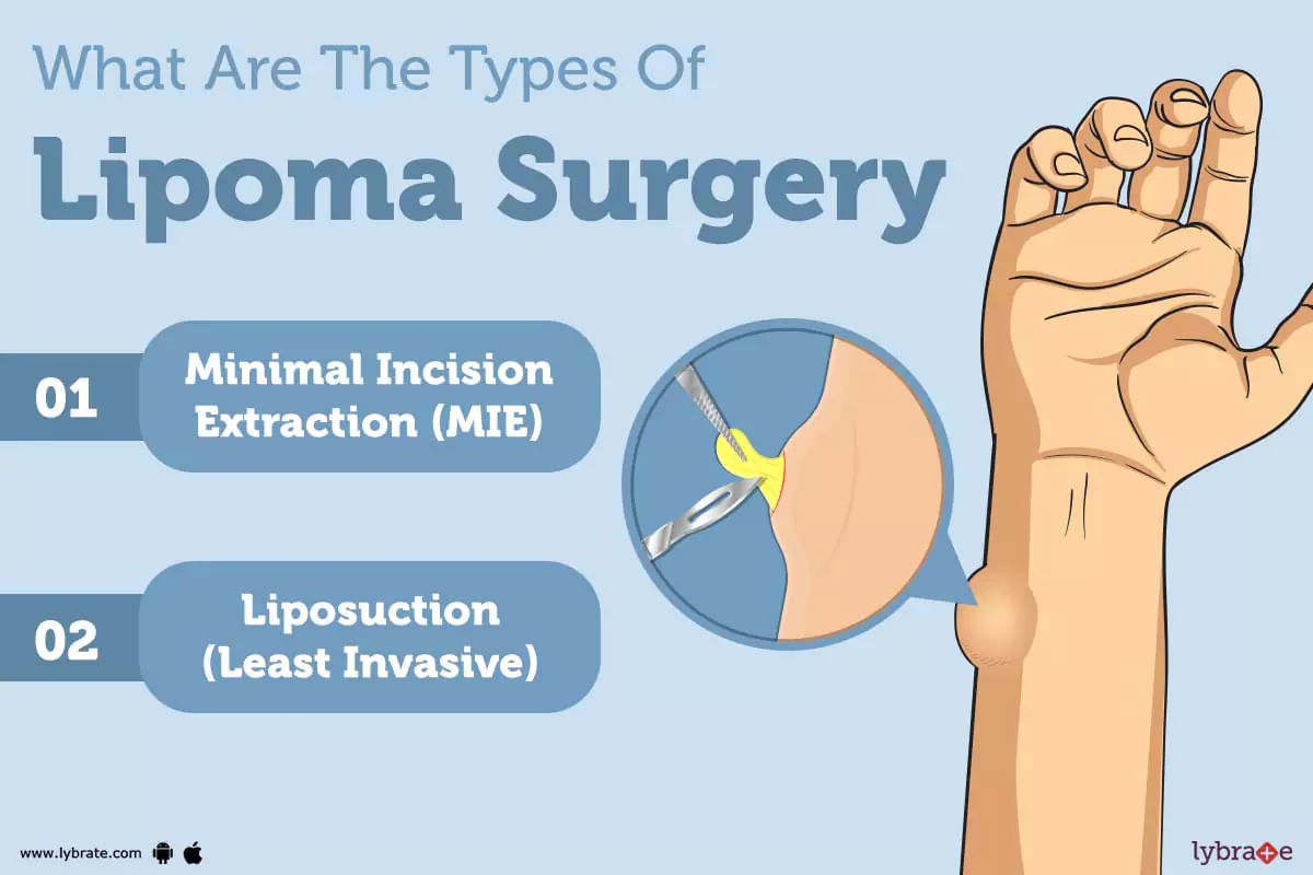 Lipoma Surgery Purpose Procedure Benefits And Side Effects 