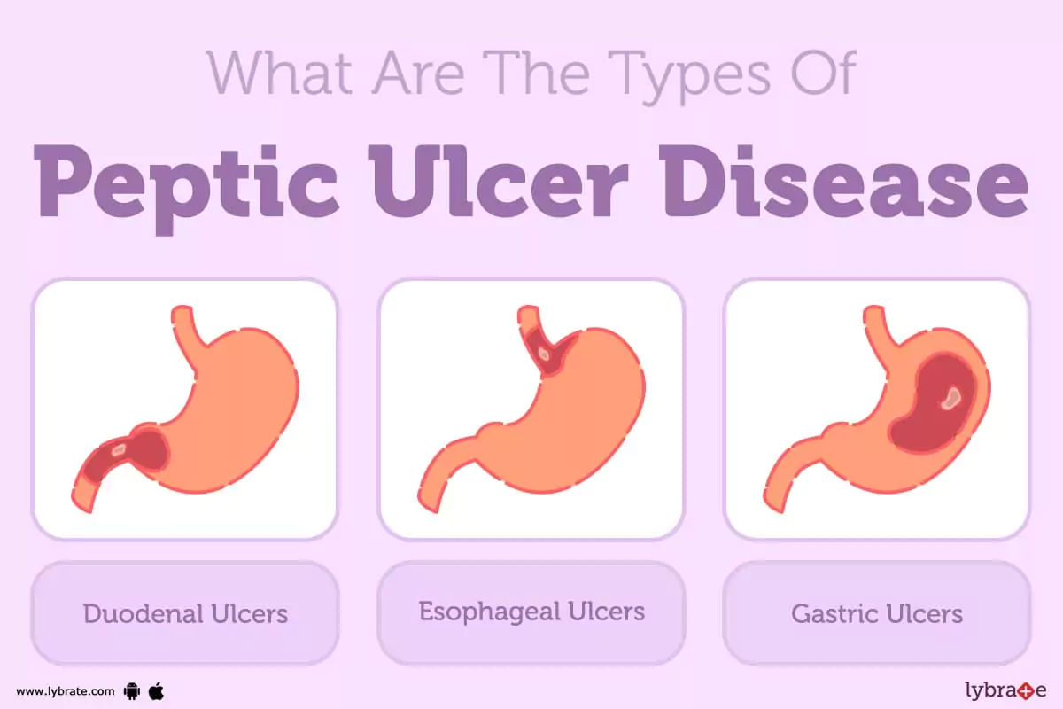 What Is Peptic Ulcer Types Causes Symptoms Treatments - vrogue.co