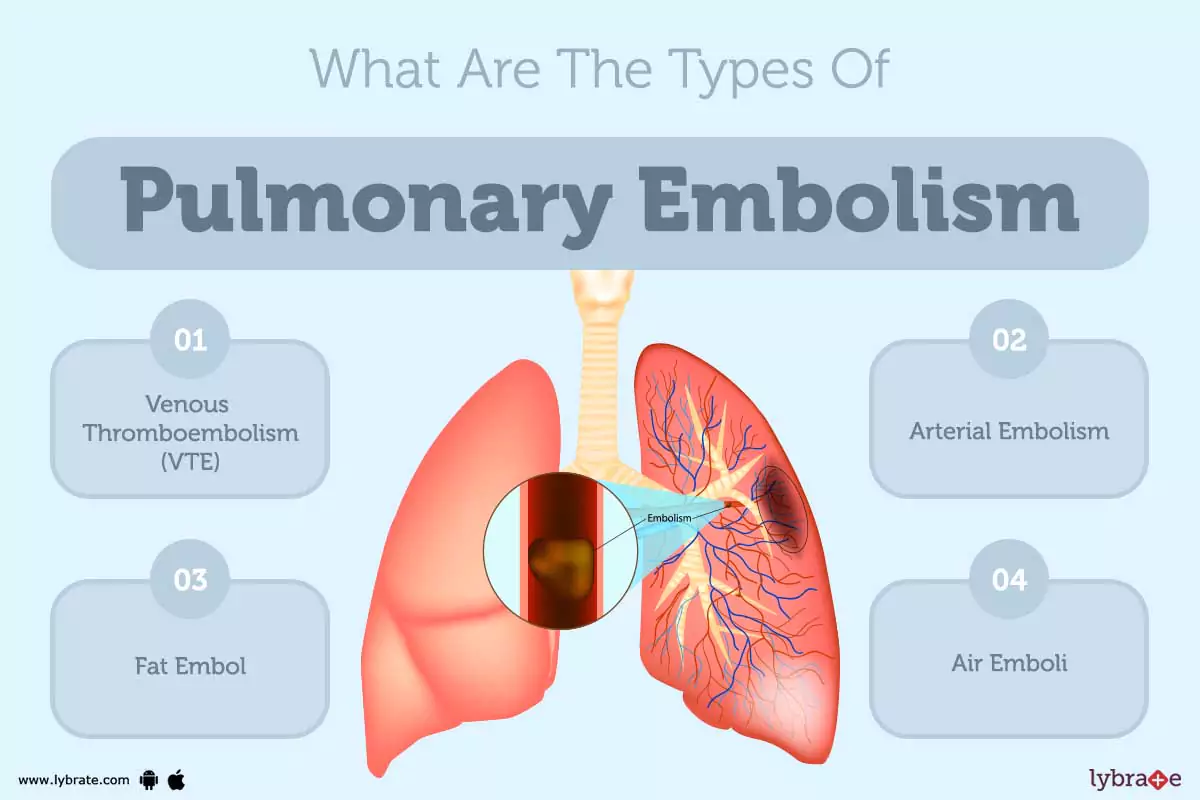 Pulmonary Embolism Causes, Symptoms, Treatment and Cost