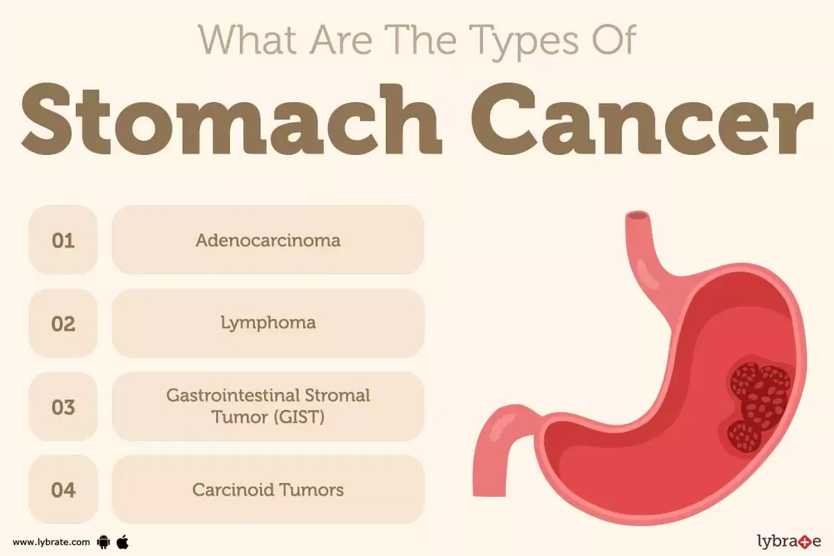 Stomach Cancer Causes, Symptoms, Treatment and Cost