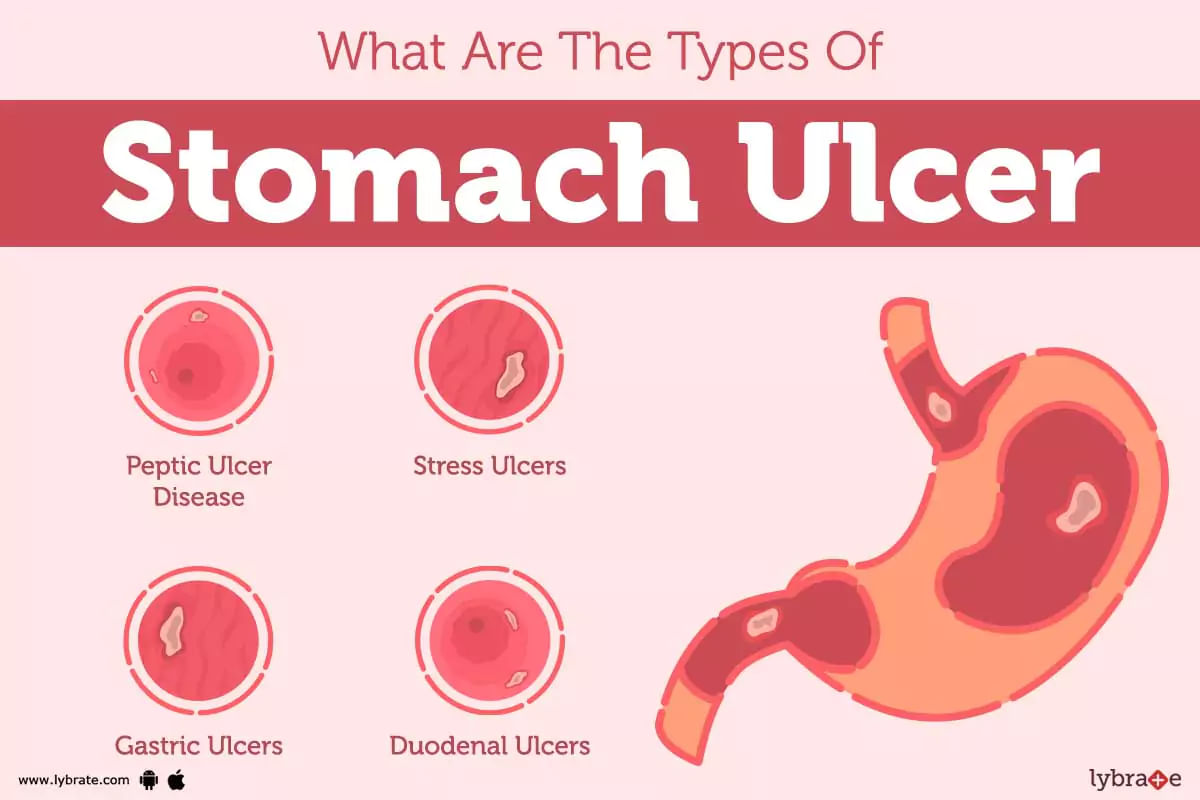 Stomach Ulcer Causes Symptoms Treatment And Cost 