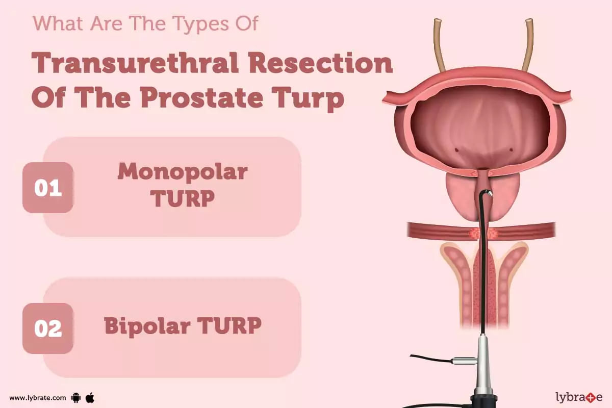 Transurethral Resection Of The Prostate Turp Purpose Procedure Benefits And Side Effects 9912