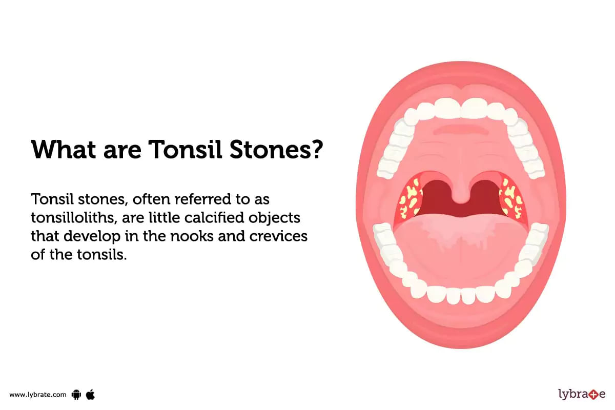 tonsil-stones-symptoms-causes-treatments-and-cost