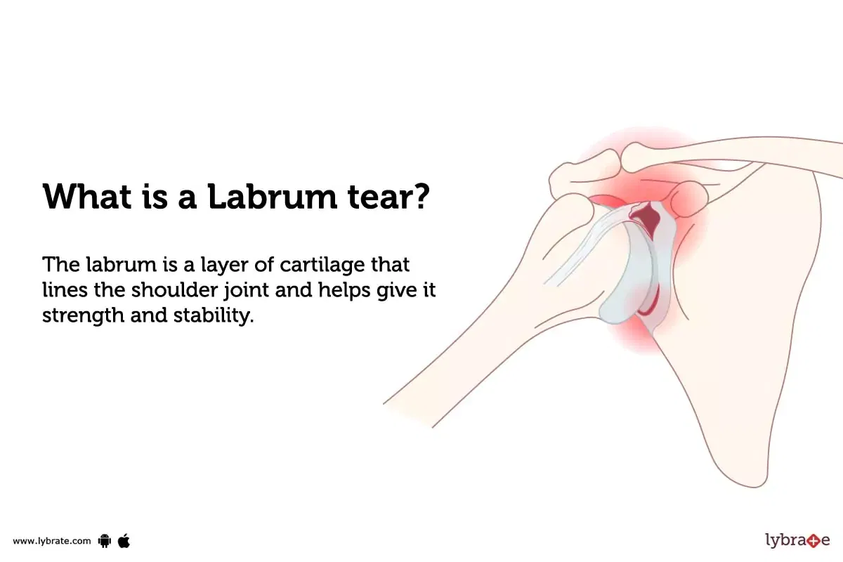 labrum-tear-causes-symptoms-treatment-and-cost