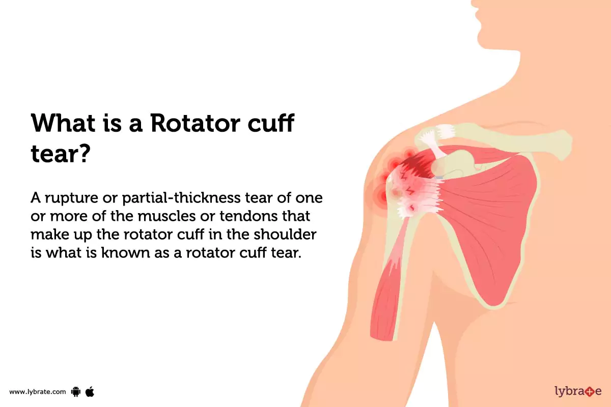 Rotator Cuff Tear Causes Symptoms Treatment And Cost rotator-cuff-tear-causes-symptoms-treatment-and-cost