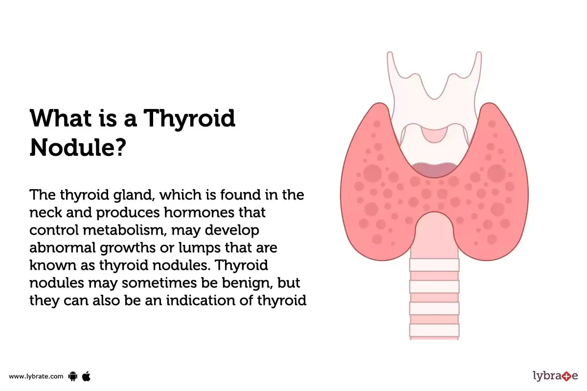 thyroid-nodule-causes-symptoms-treatment-and-cost