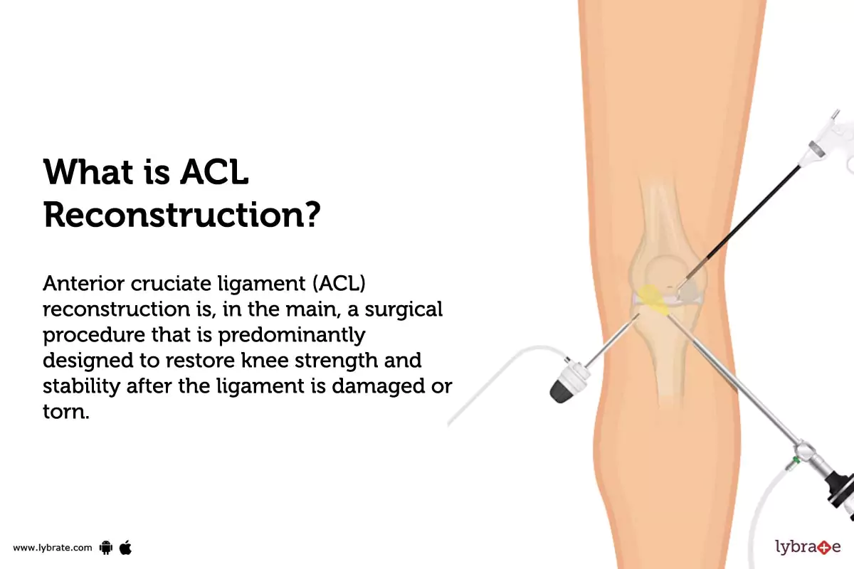Anterior Cruciate Ligament (ACL) Reconstruction Procedure, Cost, Risk