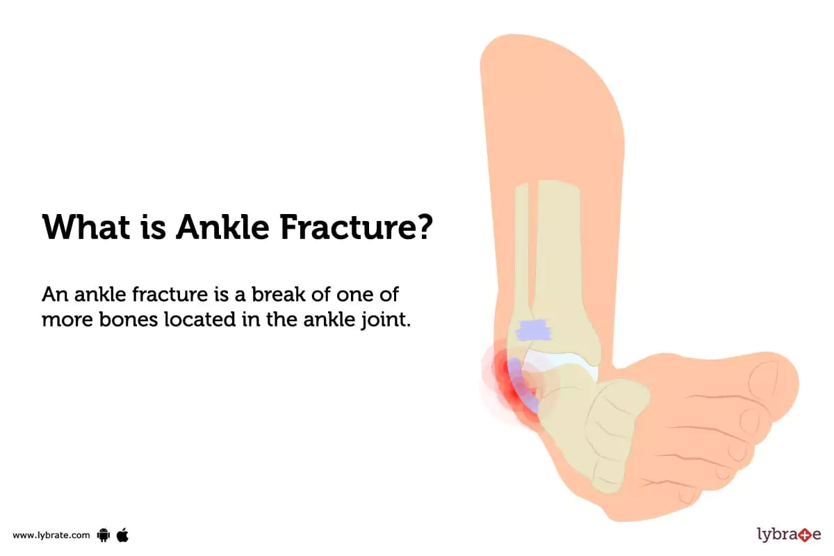 What Is Ankle Fracture.webp
