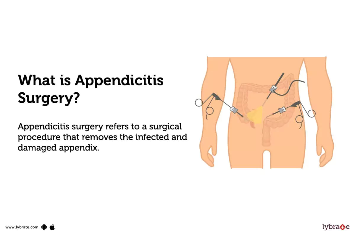 What Is Appendicitis Surgery.webp