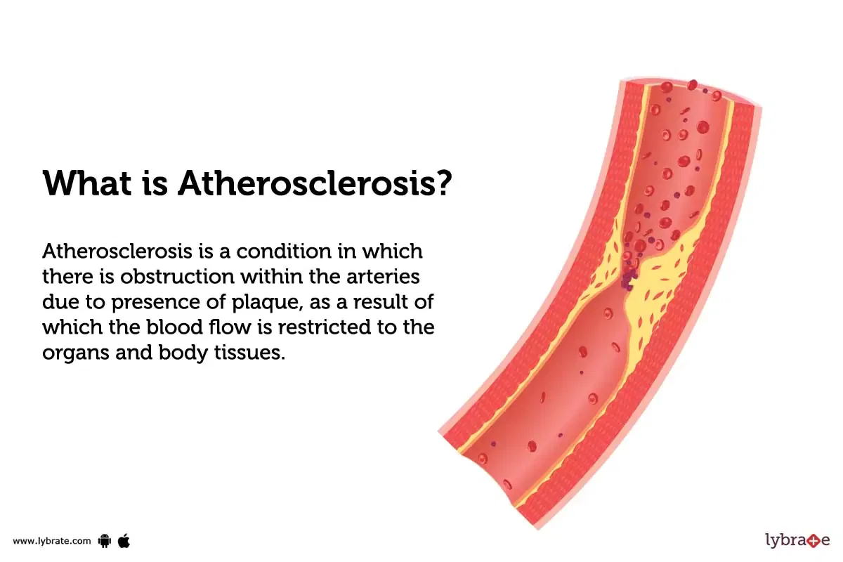 Atherosclerosis Causes Symptoms Treatment And Cost