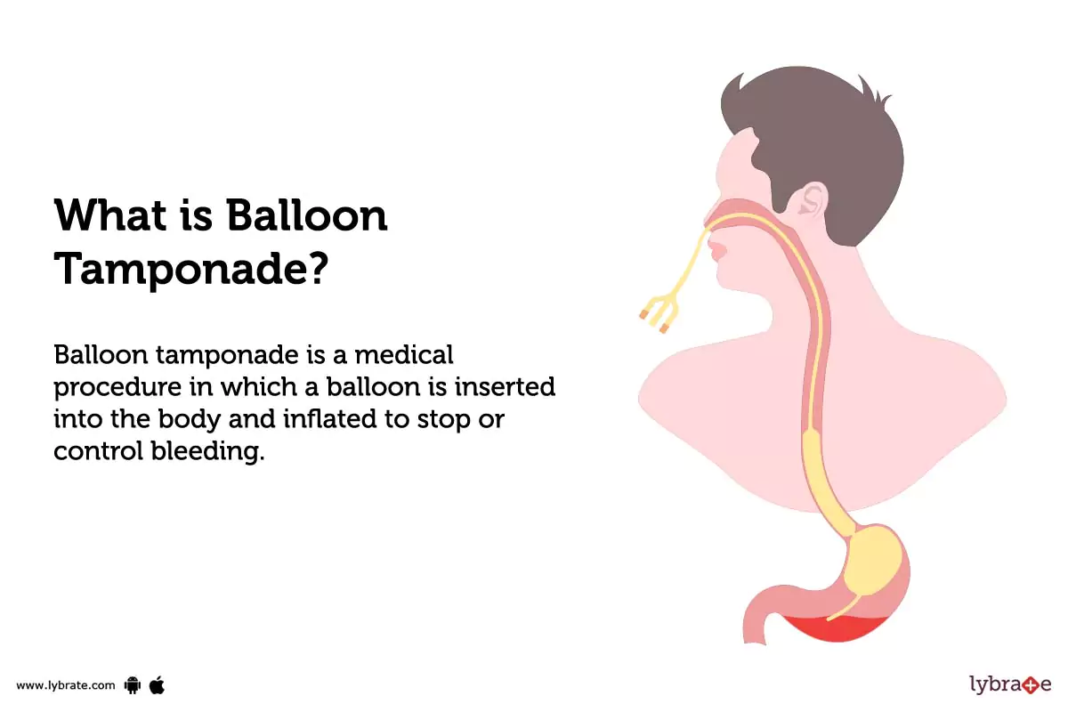 Balloon Tamponade Purpose, Procedure, Benefits and Side Effects