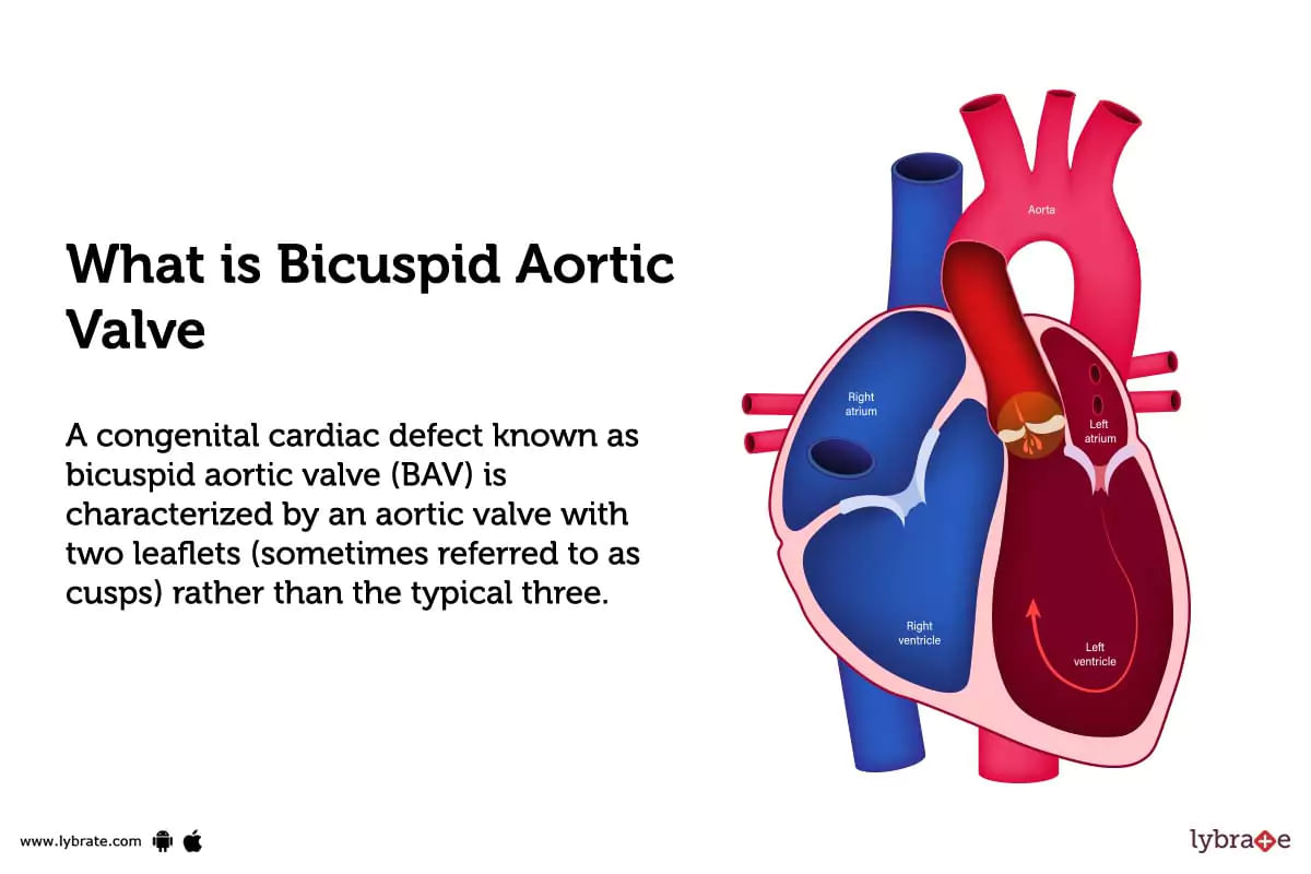Bicuspid Aortic Valve Treatment Procedure Cost Recovery Side Effects And More