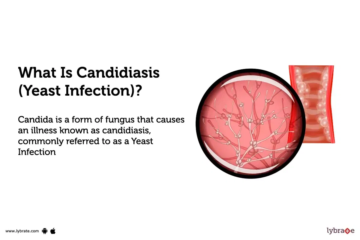 Candidiasis (Yeast Infection) Causes, Symptoms, Treatment and Cost