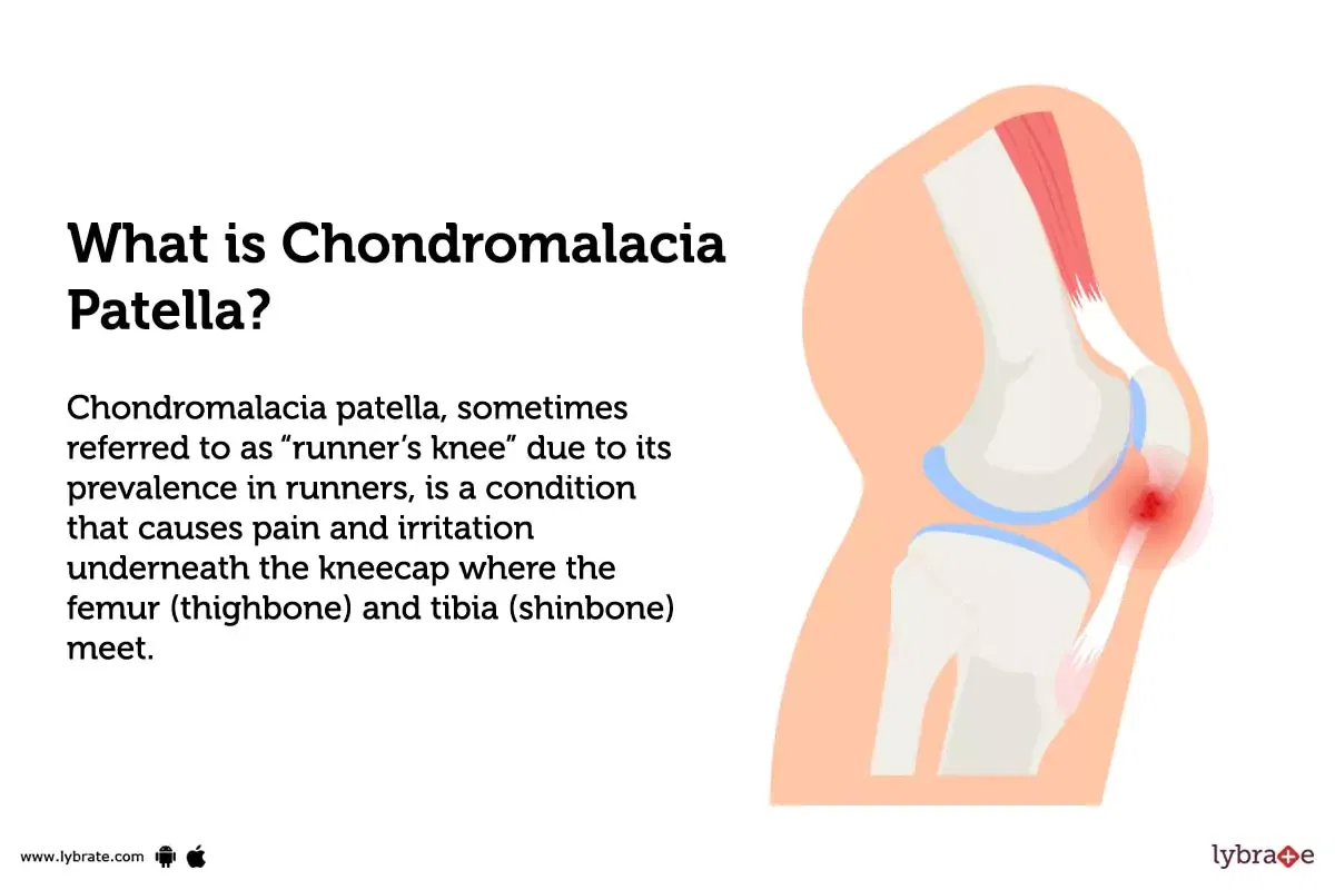 Chondromalacia Patella Causes Symptoms Treatment And Cost