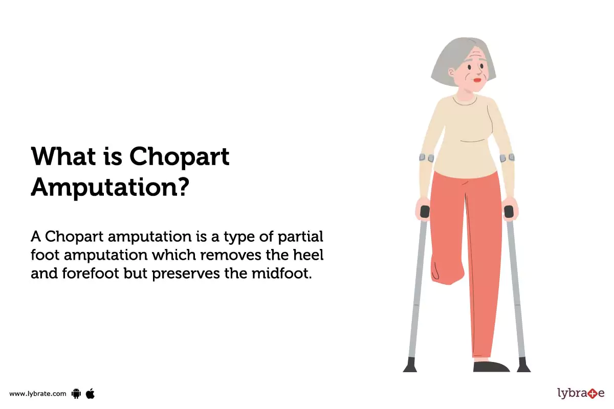 Chopart Amputation Purpose, Procedure, Benefits and Side Effects