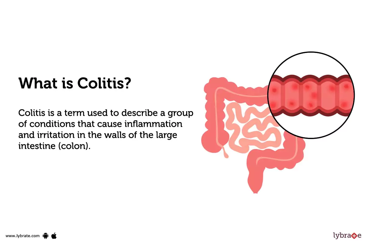 colitis Treatment, Procedure, Cost, Recovery, Side Effects And More