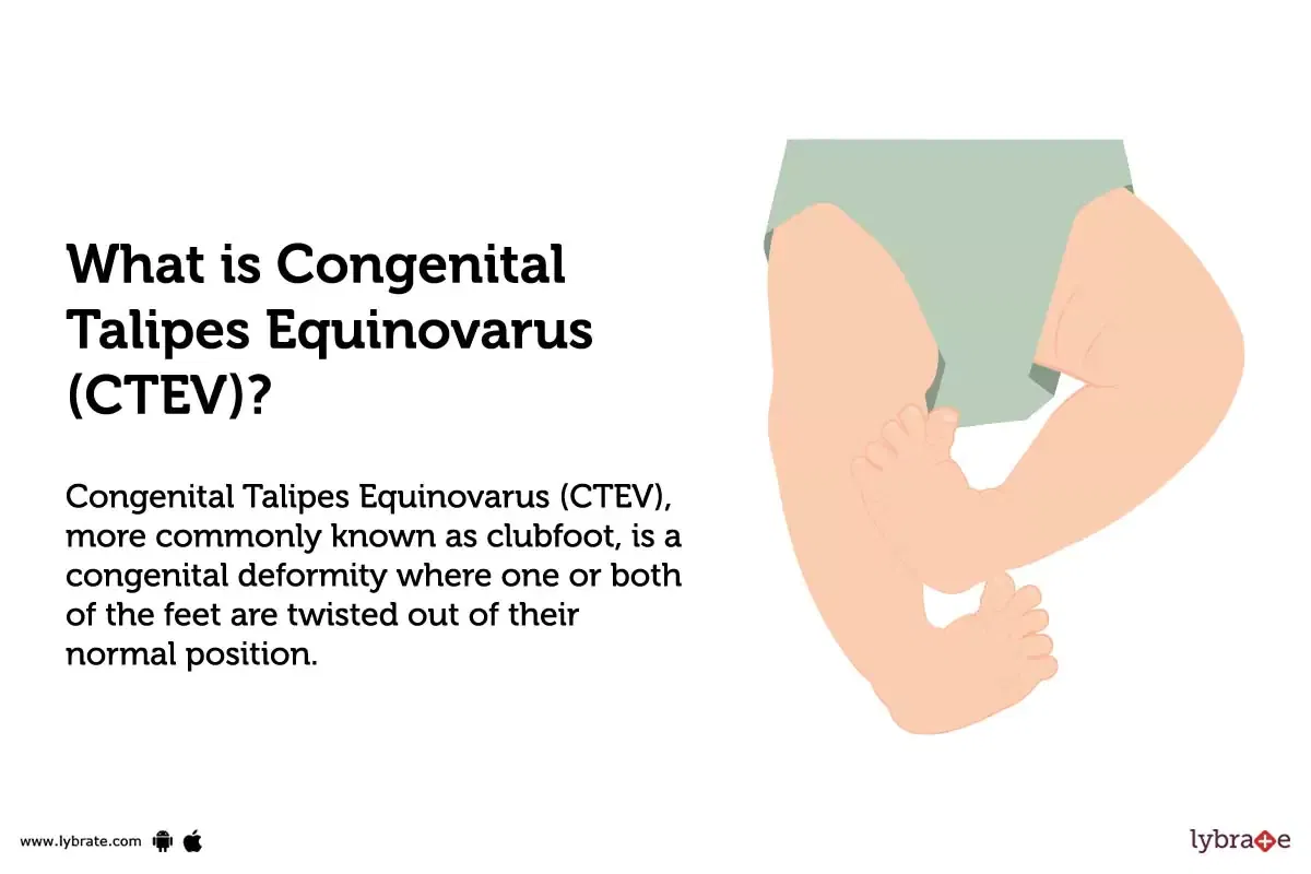 Congenital Talipes Equinovarus (CTEV) Causes, Symptoms, Treatment and Cost