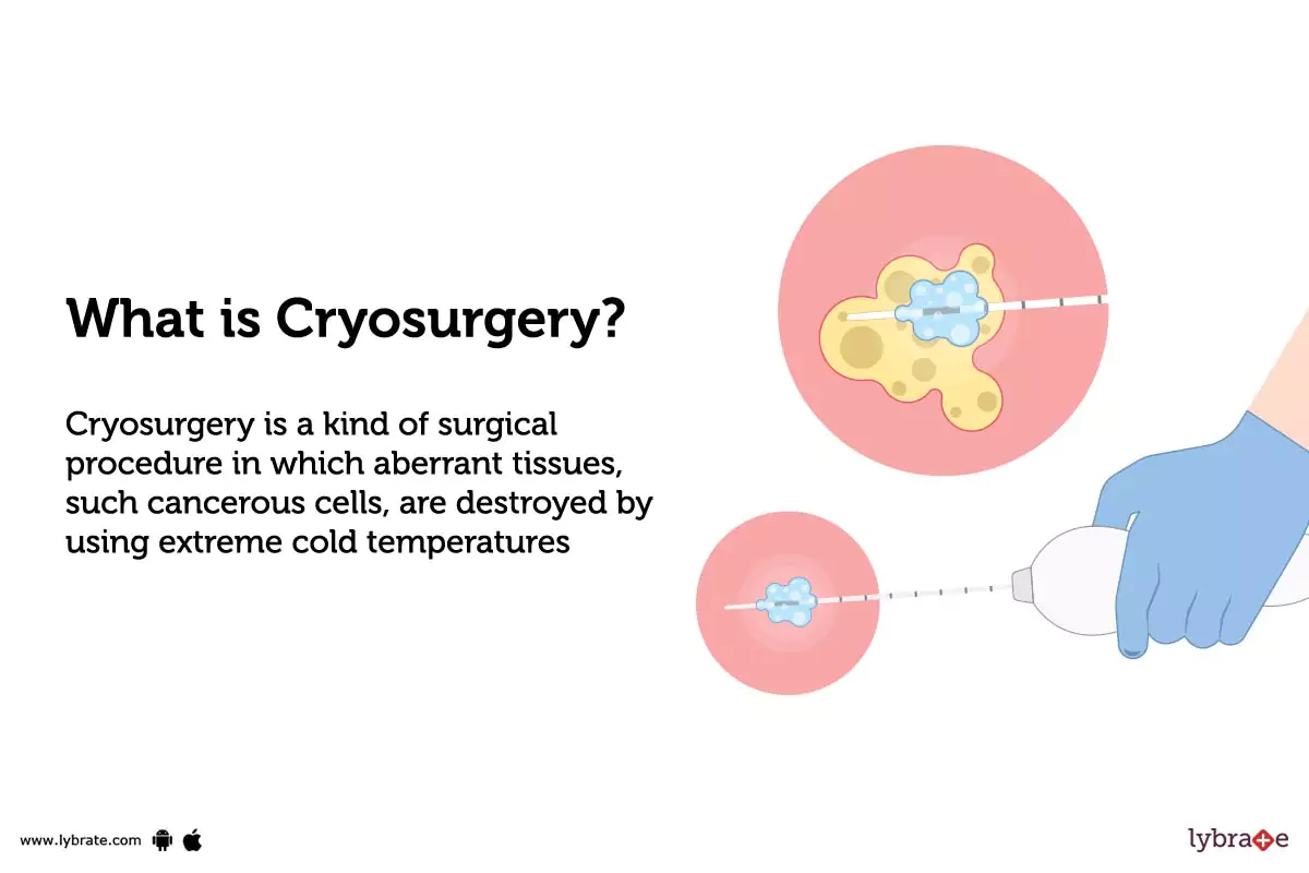 Cryosurgery Purpose, Procedure, Benefits and Side Effects