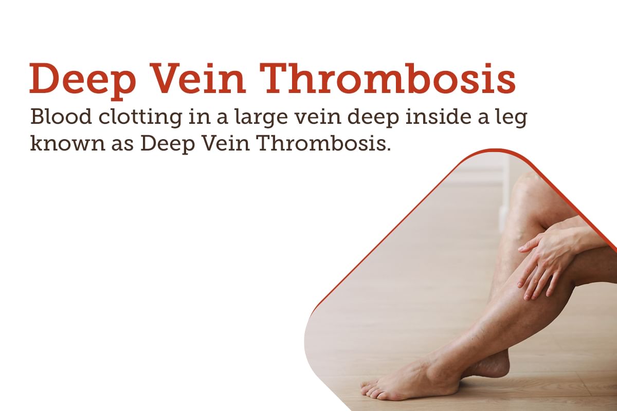 Deep Vein Thrombosis - Dvt: Treatment, Procedure, Cost, Recovery, Side 