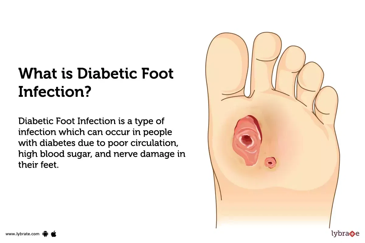 diabetic-foot-infection-causes-symptoms-treatment-and-cost