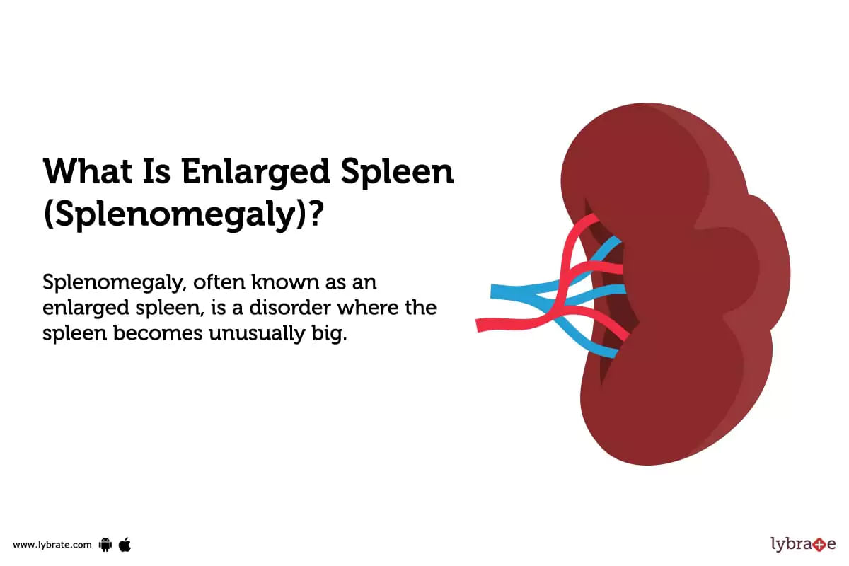 Enlarged Spleen Splenomegaly Causes Symptoms Treatment And Cost