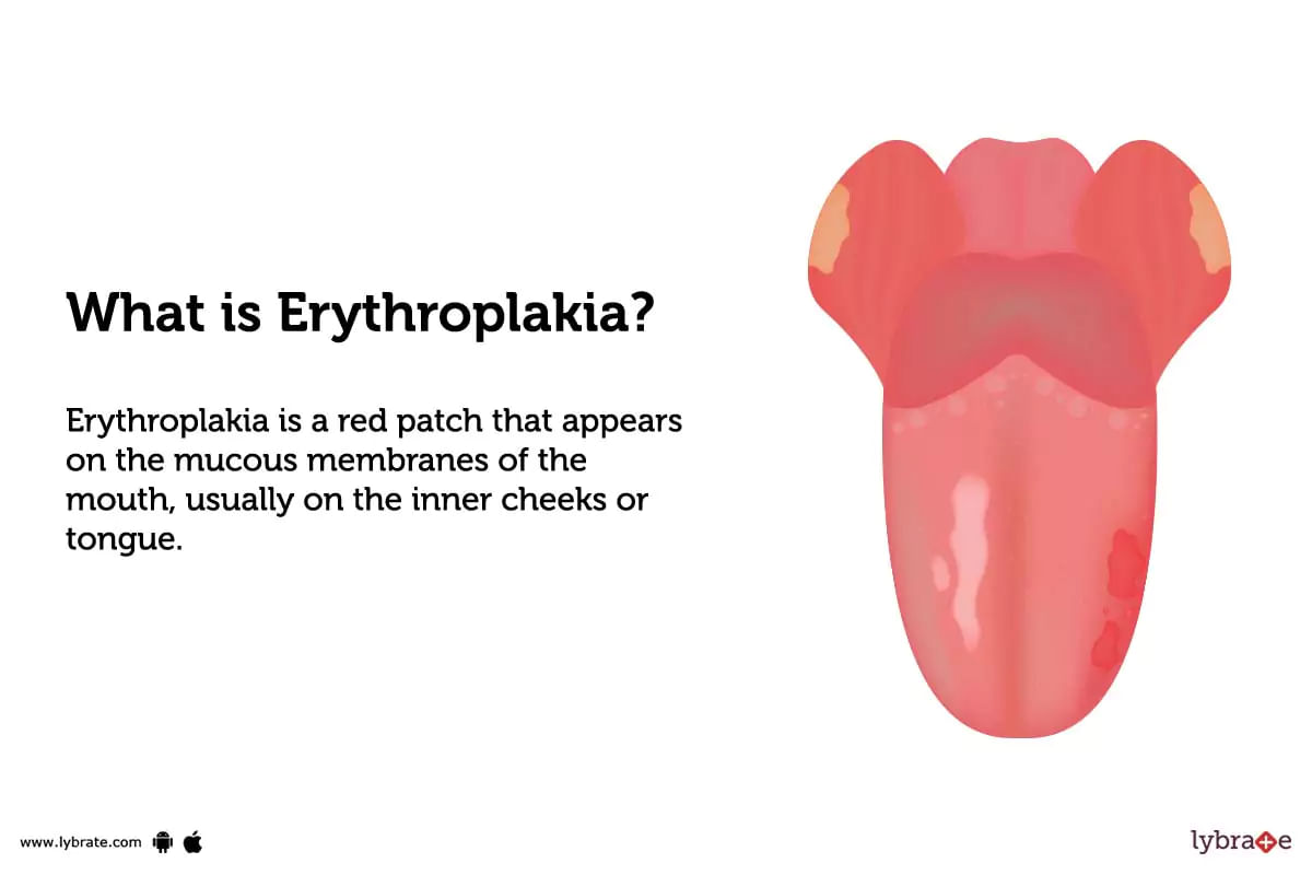 Erythroplakia Causes Symptoms Treatment And Cost