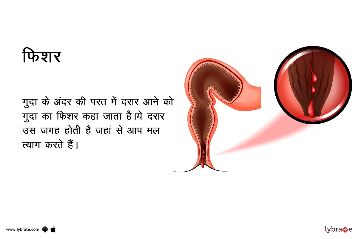 फिशर के लक्षण, कारण, इलाज, दवा, उपचार और परहेज Fissure in Hindi