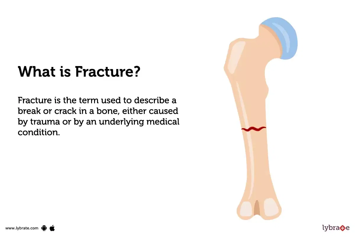 Fracture Causes, Symptoms, Treatment and Cost